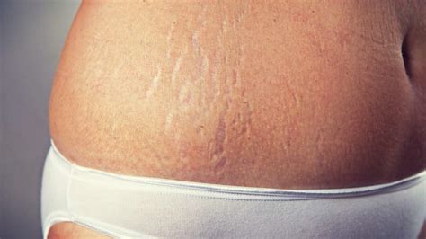 Can You Get Rid of Stretch Marks After Pregnancy? And Why Do Bananas Never Wear Sunscreen?