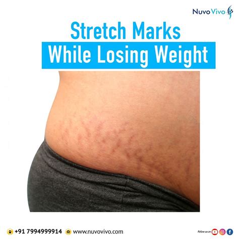 Will Stretch Marks Go Away If I Lose Weight? And Can You Turn Them Into a Fashion Statement?